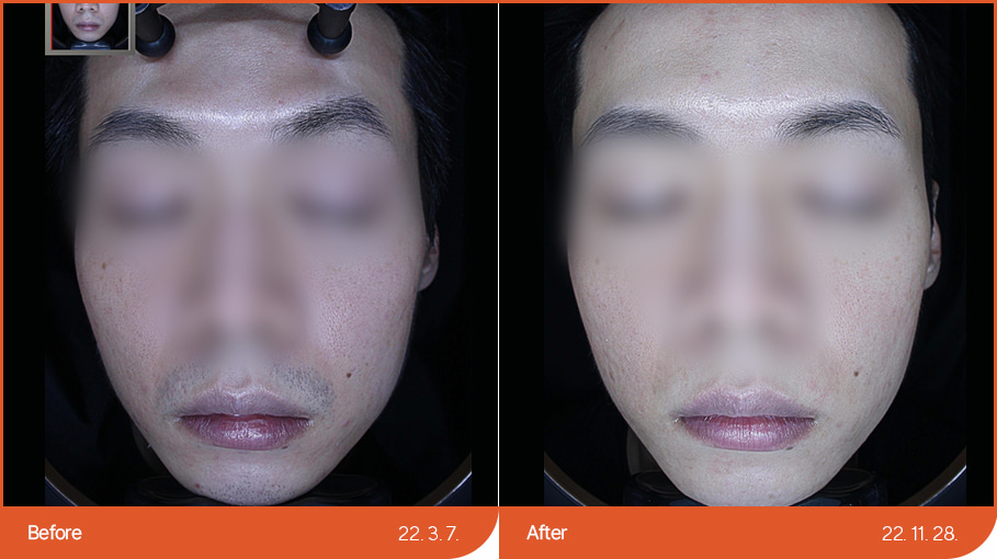 Laser hair removal 04