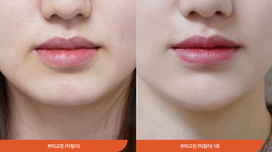 Bibir, dagu, dan leher 01