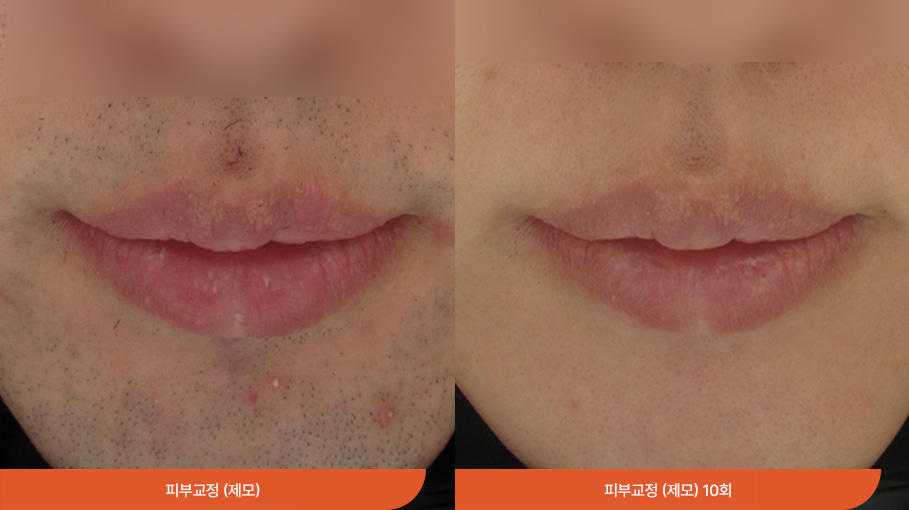 Laser hair removal 05
