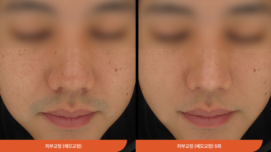 Laser hair removal 06