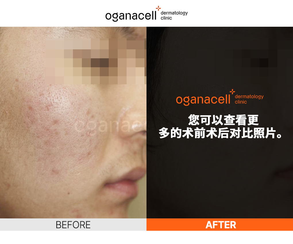 韩国Oganacell皮肤科清潭店- 超声刀Primus - Oganacell Dermatology Clinic