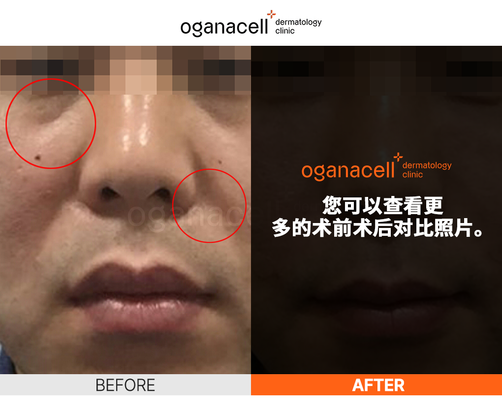 韩国Oganacell皮肤科清潭店- 超声刀Primus - Oganacell Dermatology Clinic