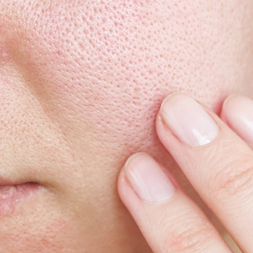 Skin with Large Pores