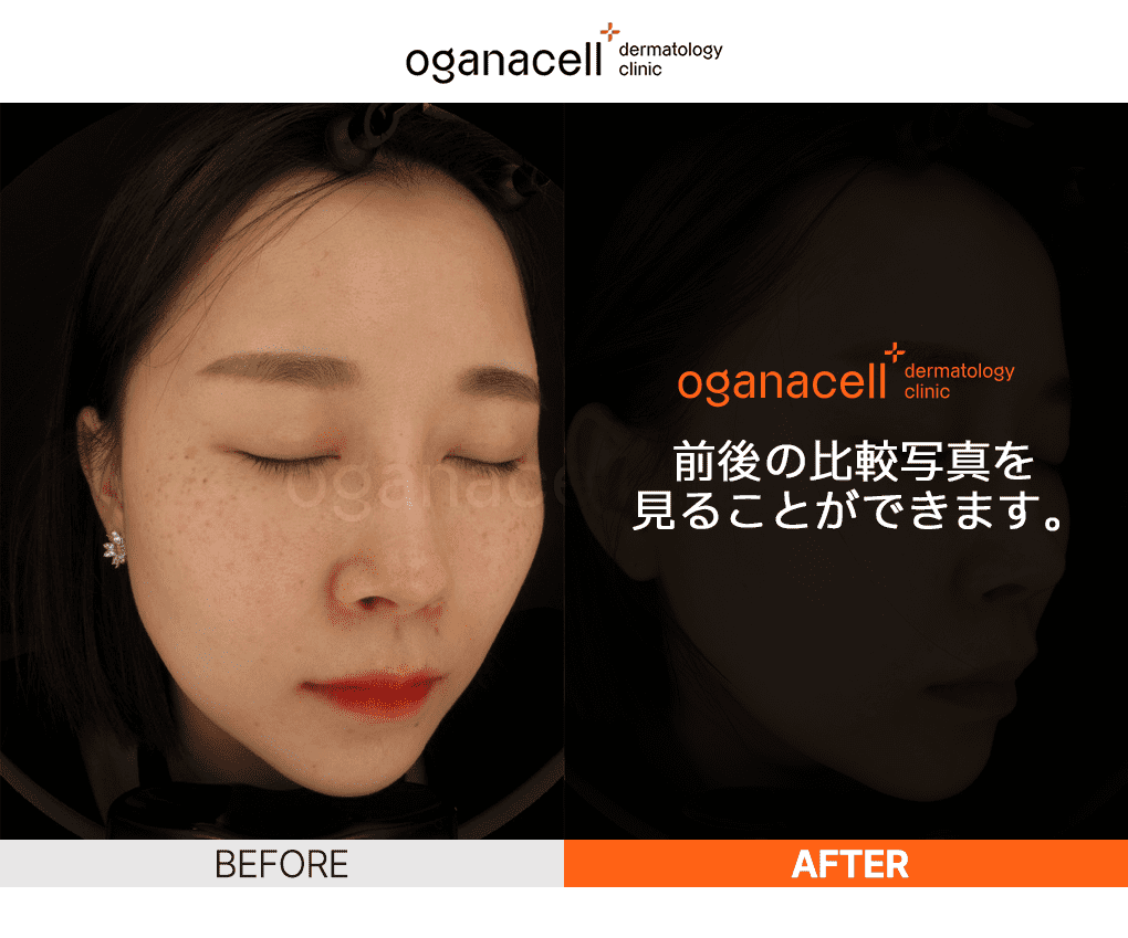 韓国ソウルのプレミアム皮膚科、オガナセルの施術前後の写真です。 クリックして、より多くの写真を確認してください。