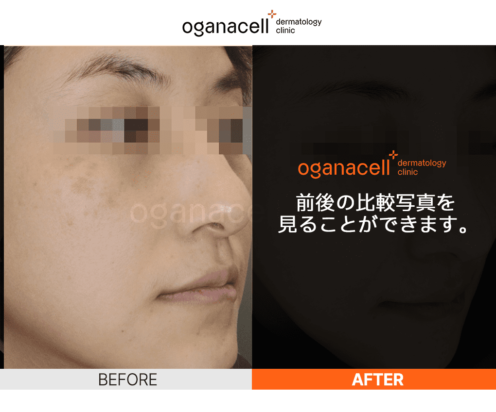 韓国ソウルのプレミアム皮膚科、オガナセルの施術前後の写真です。 クリックして、より多くの写真を確認してください。